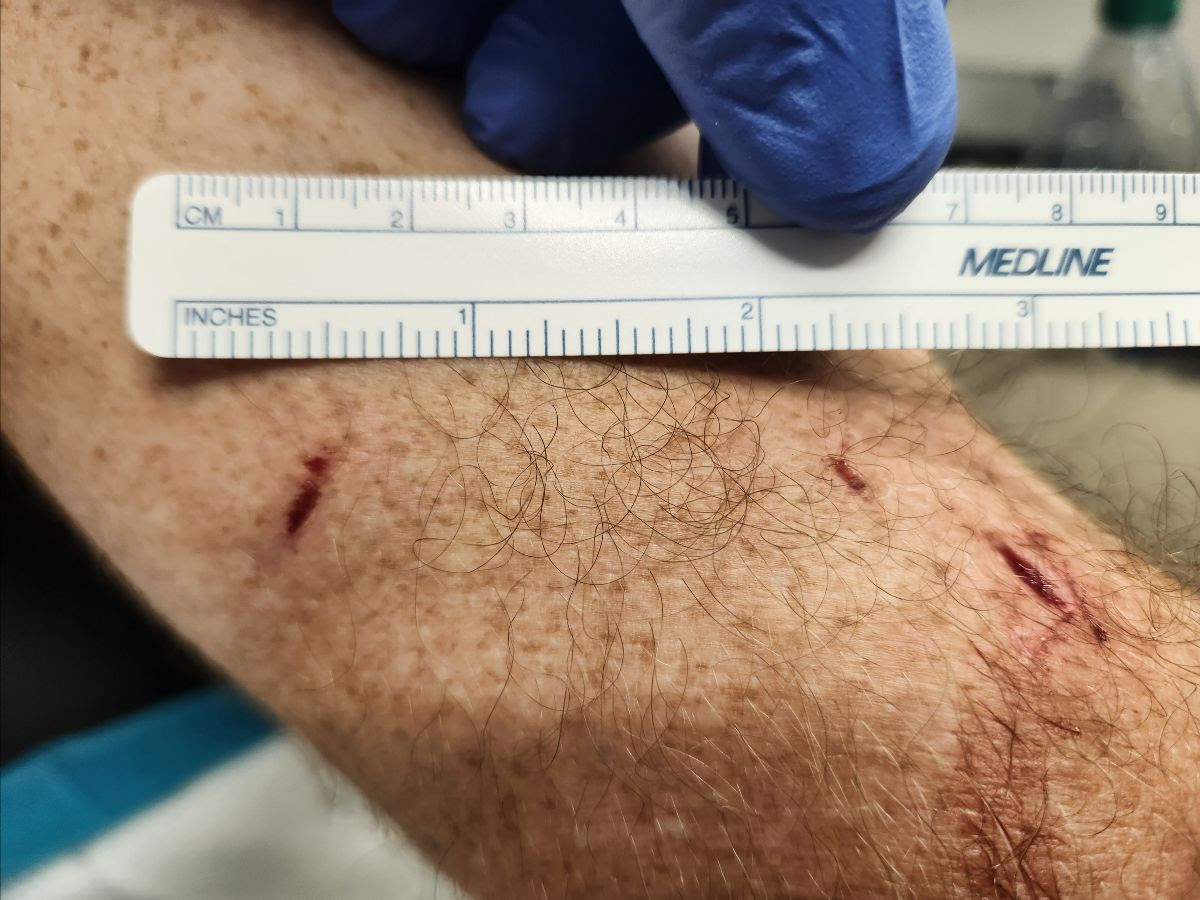 Colorado wildlife officials continue search for bear that attacked man in hammock